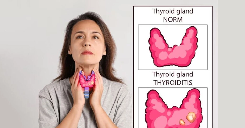Thyroid Issues in Women: Expert Solutions Offered