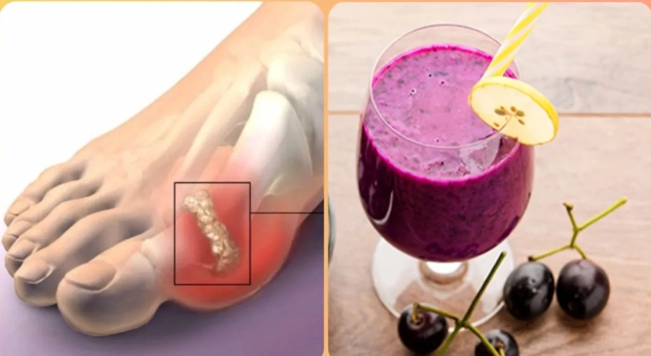 Reduce Uric Acid: Smoothie Recipe with Digestible Fruit
