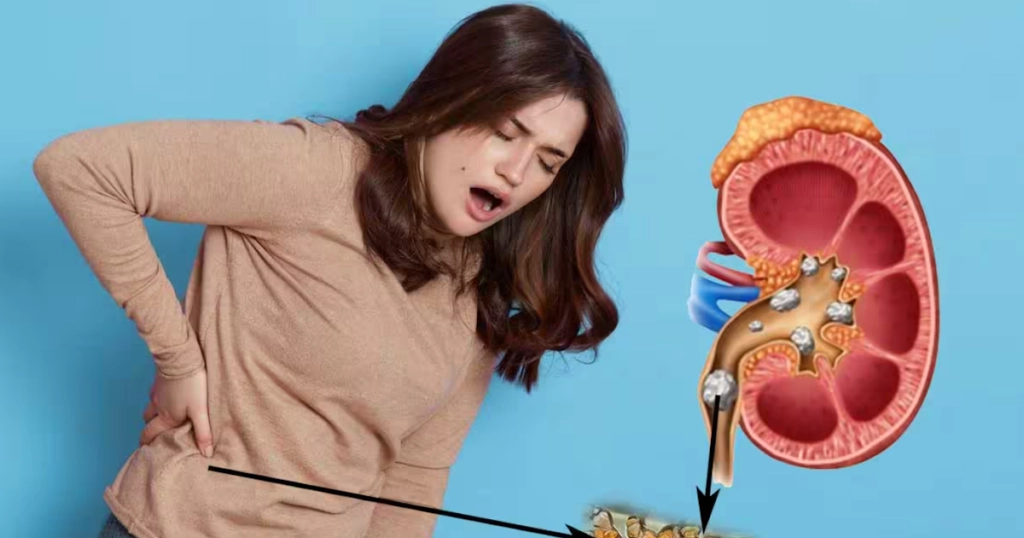 5 Warning Signs Your Body Shows Before Stone Formation