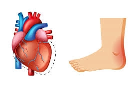Persistent Leg Swelling: A Possible Sign of Heart Failure