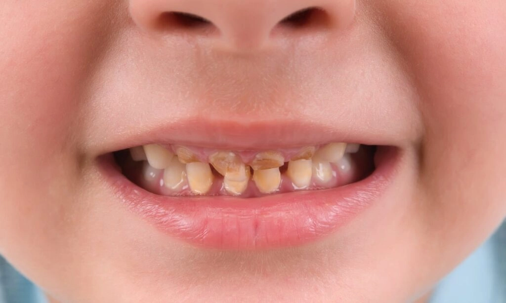 6 Everyday Drinks That Can Harm Your Dental Health