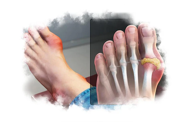 Lower Uric Acid: Remove These 5 Foods and Add These 5