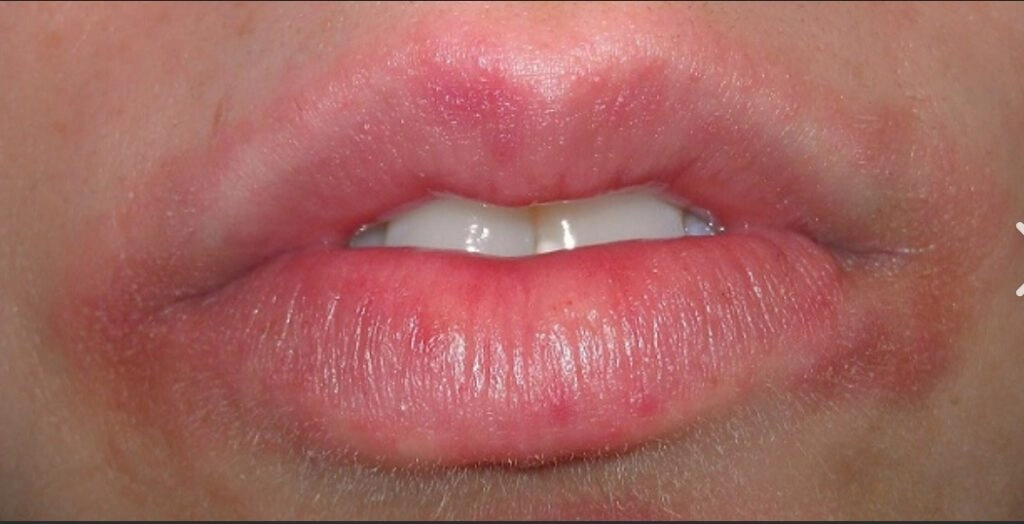 Swollen, Itchy, Red Lips? It Might Be an Allergy