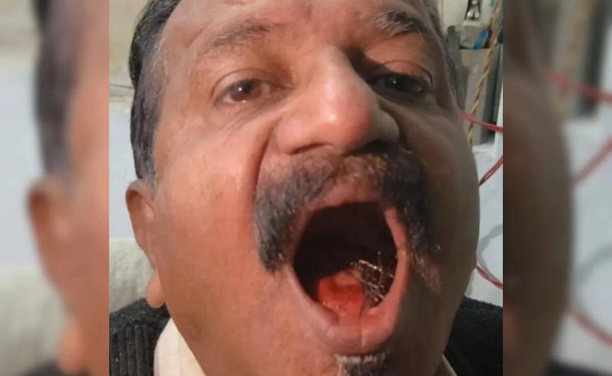 Man Carries Sharp Pins in Mouth for 45 Years; Shocks Users