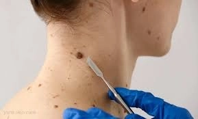 Removing Warts at Home: Increased Skin Cancer Risk Explained