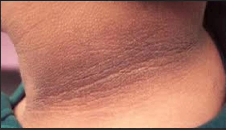Don’t Ignore Black Neck: 4 Diseases You Should Know