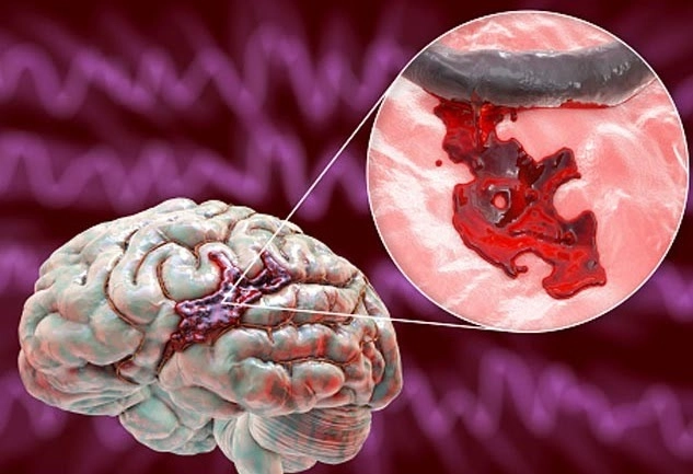 Signs of a Brain Nerve Burst: Know the Early Indicators