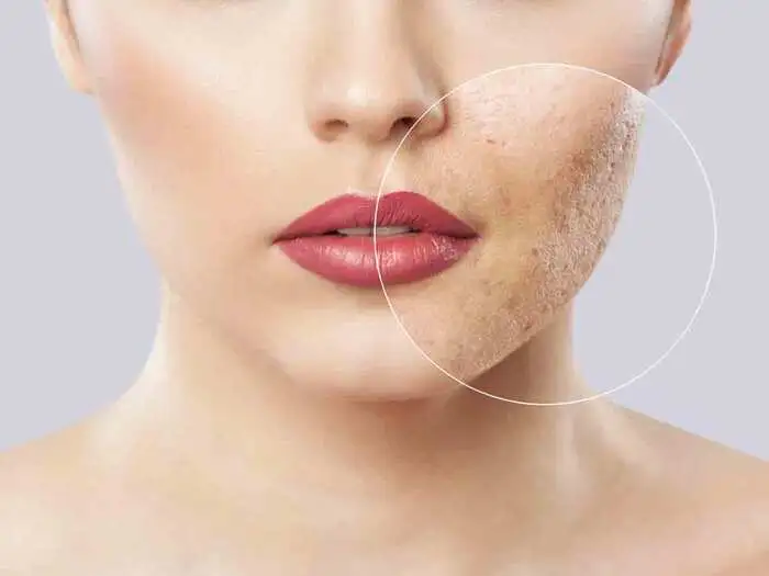 Effective Home Remedies for Dark Spots on Face