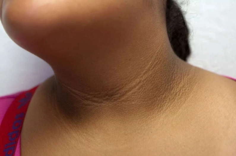 Black Neck Line: A Warning Sign of Potential Disease