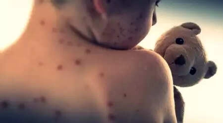 Measles Alert Issued in Sydney as Cases Rise in New South Wales