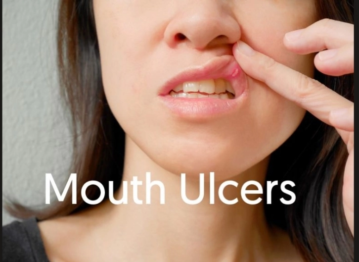 Understanding Recurring Mouth Ulcers: Easy Prevention Tips