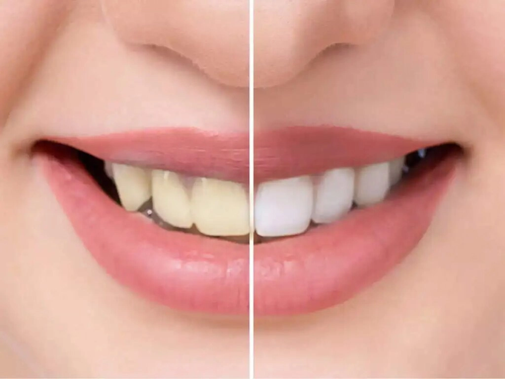 Effective Home Remedies for Whiter Teeth