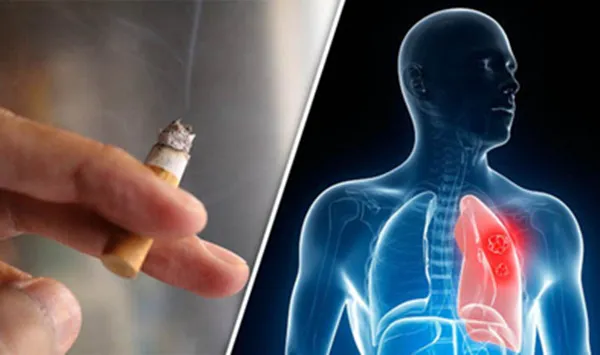 Lung Cancer Rising in Youth Even Without Smoking, Shocking Study
