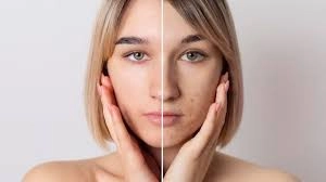 Kitchen Remedies for Freckles and Pigmentation in Skin Care