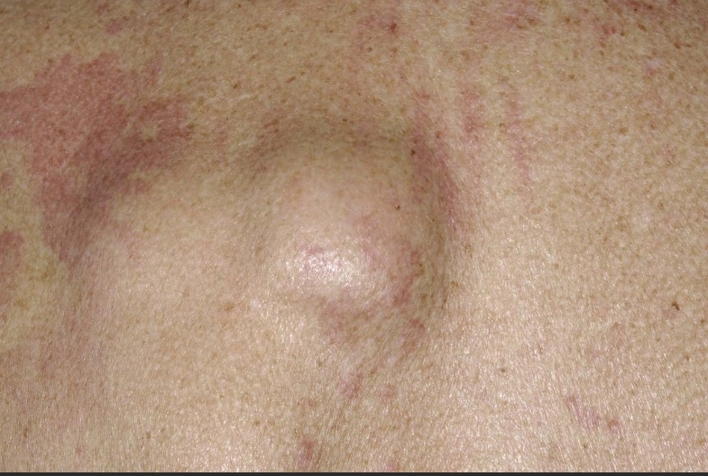 Symptoms and Treatment of Lipoma: Don’t Ignore This Issue