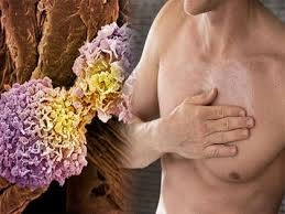 Men at Risk: Know Breast Cancer Symptoms and Causes Early