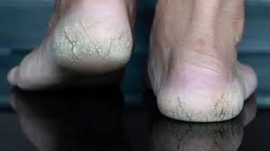 Quick Homemade Foot Cream for Cracked Heels This Summer