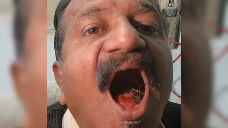 Shocking Case: Man Keeps Pin in Mouth for 45 Years, Doctors Stunned